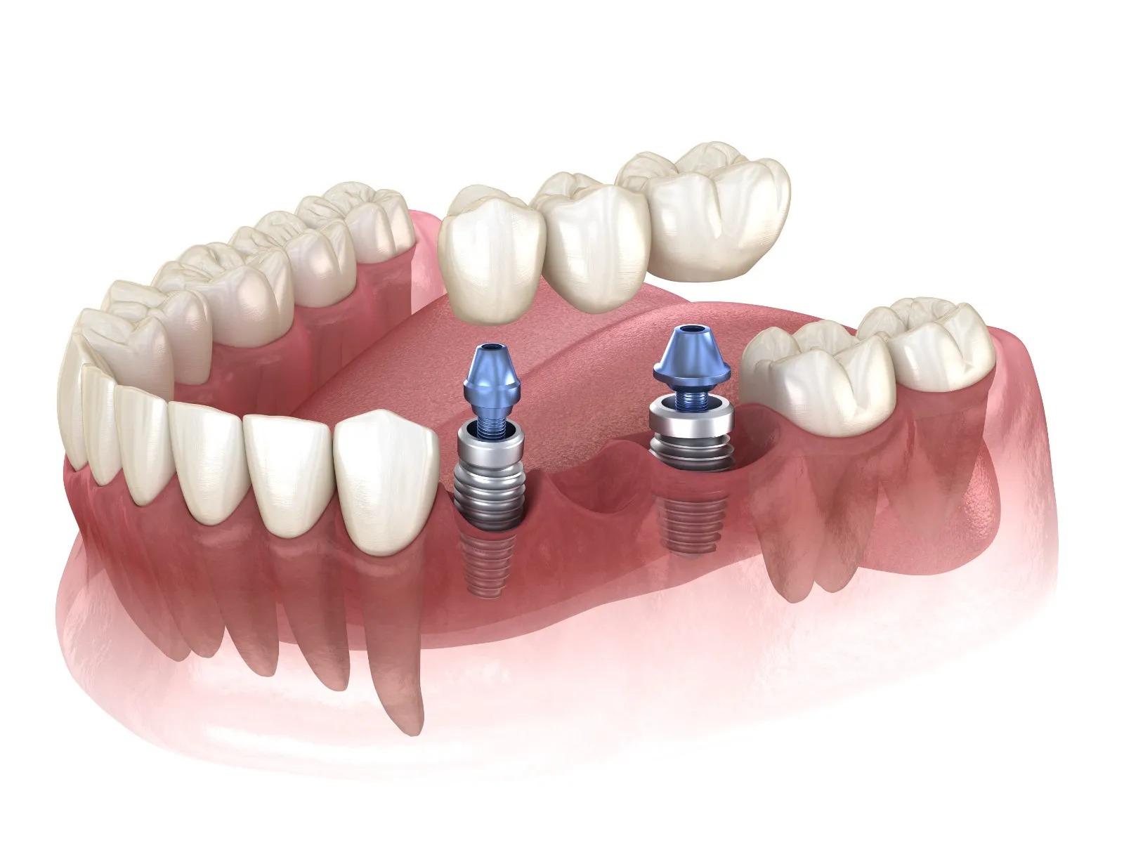 Dental implant in Chennai – Smile Life Dental Clinic offering affordable tooth replacement, advanced teeth implant procedure, and natural smile restoration